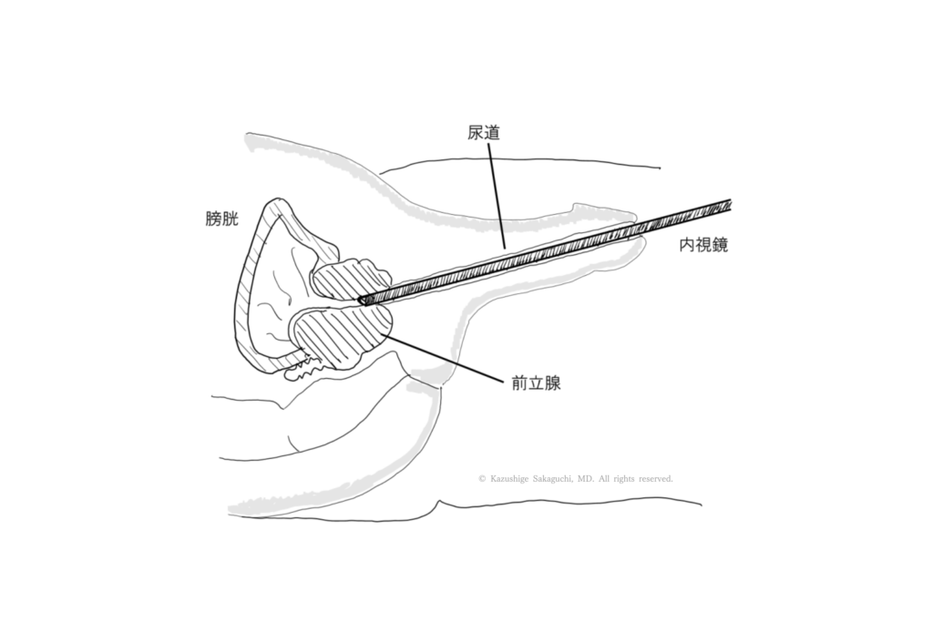 尿道から内視鏡を挿入し、前立腺内腺を核出するHoLEP手術の模式図