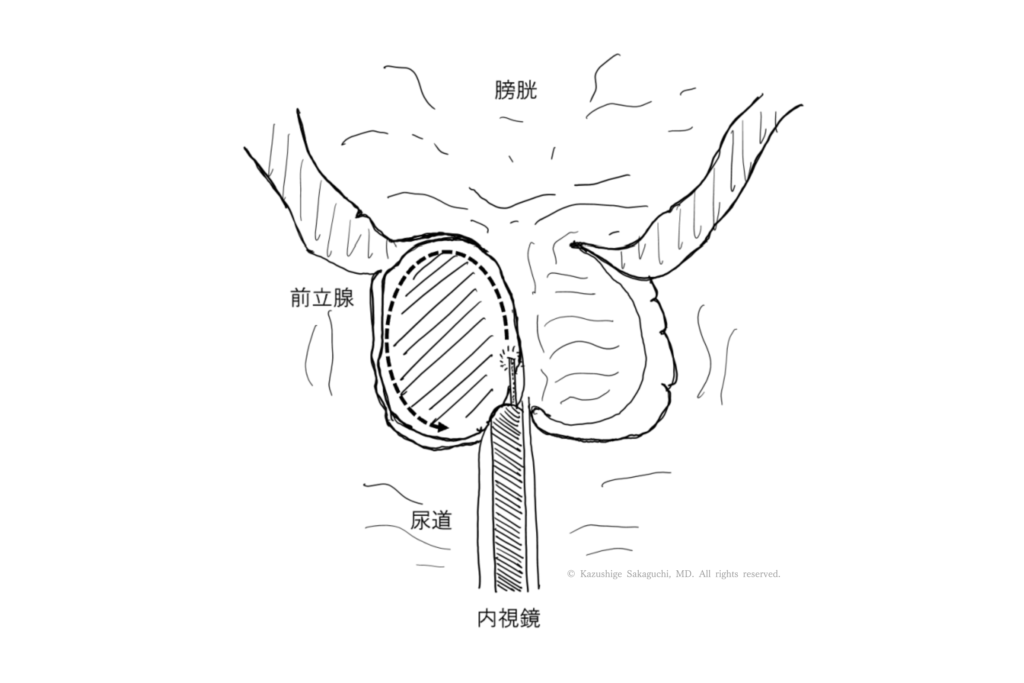 HoLEPで核出される前立腺内腺の範囲を示した模式図