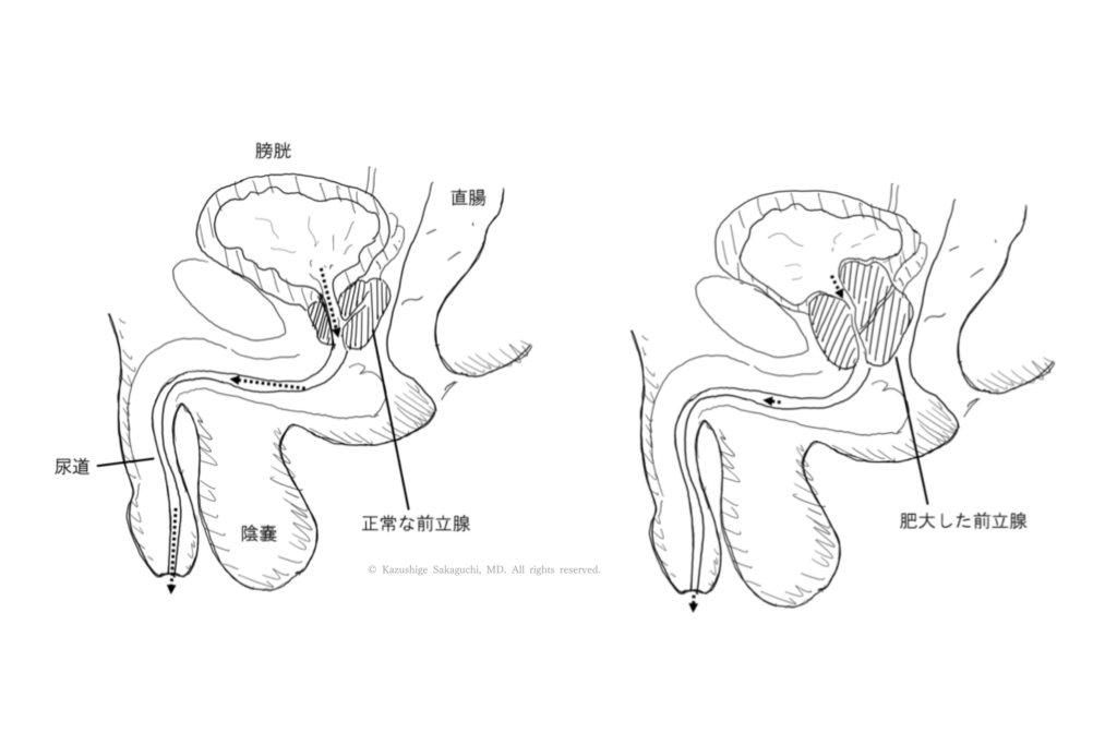 正常な前立腺と、肥大して尿道を圧迫している前立腺を比較した図です。
