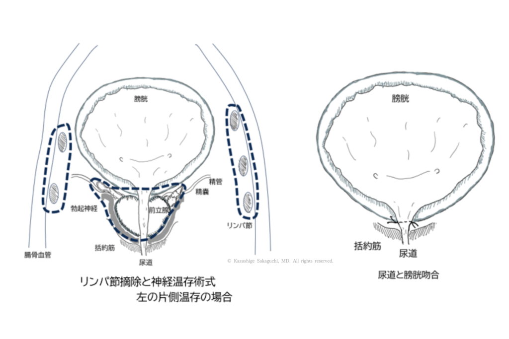 ロボット支援前立腺全摘でのリンパ節郭清と神経温存を示した図