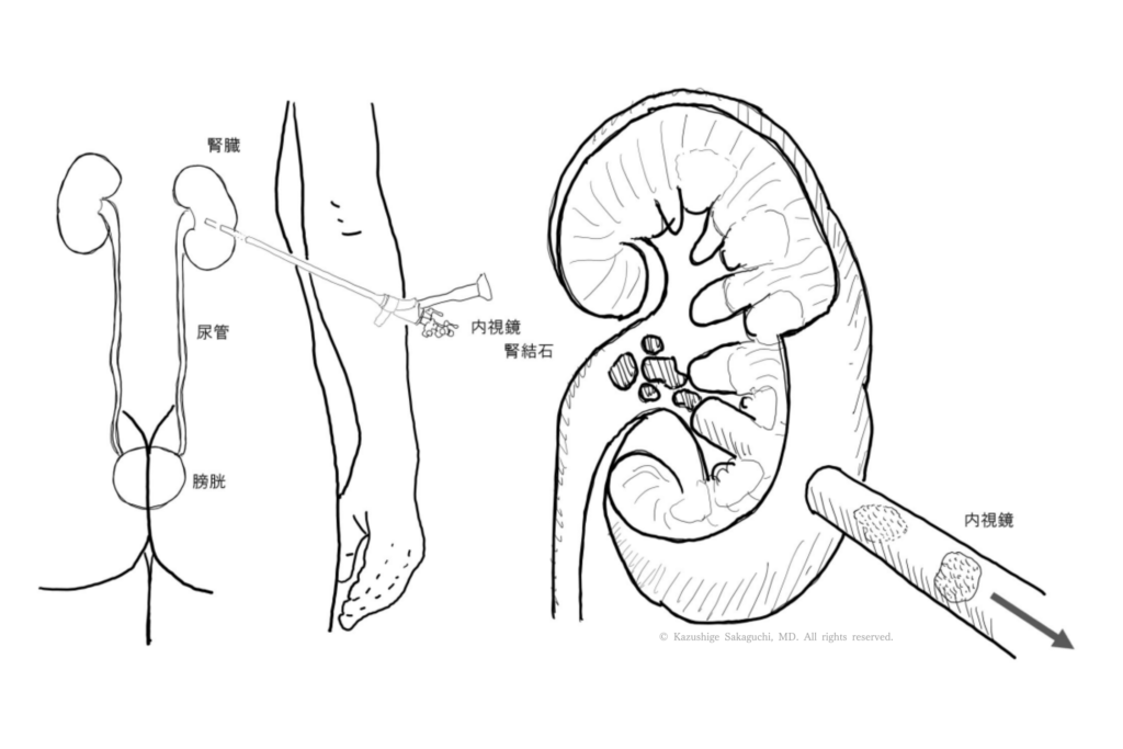 PNL（経皮的腎結石除去術）で、背中側から腎臓に内視鏡を挿入し、腎結石を直接破砕・除去する様子を示した模式図です。