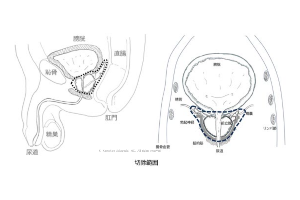 ロボット支援前立腺全摘で切除される前立腺の範囲を示した図