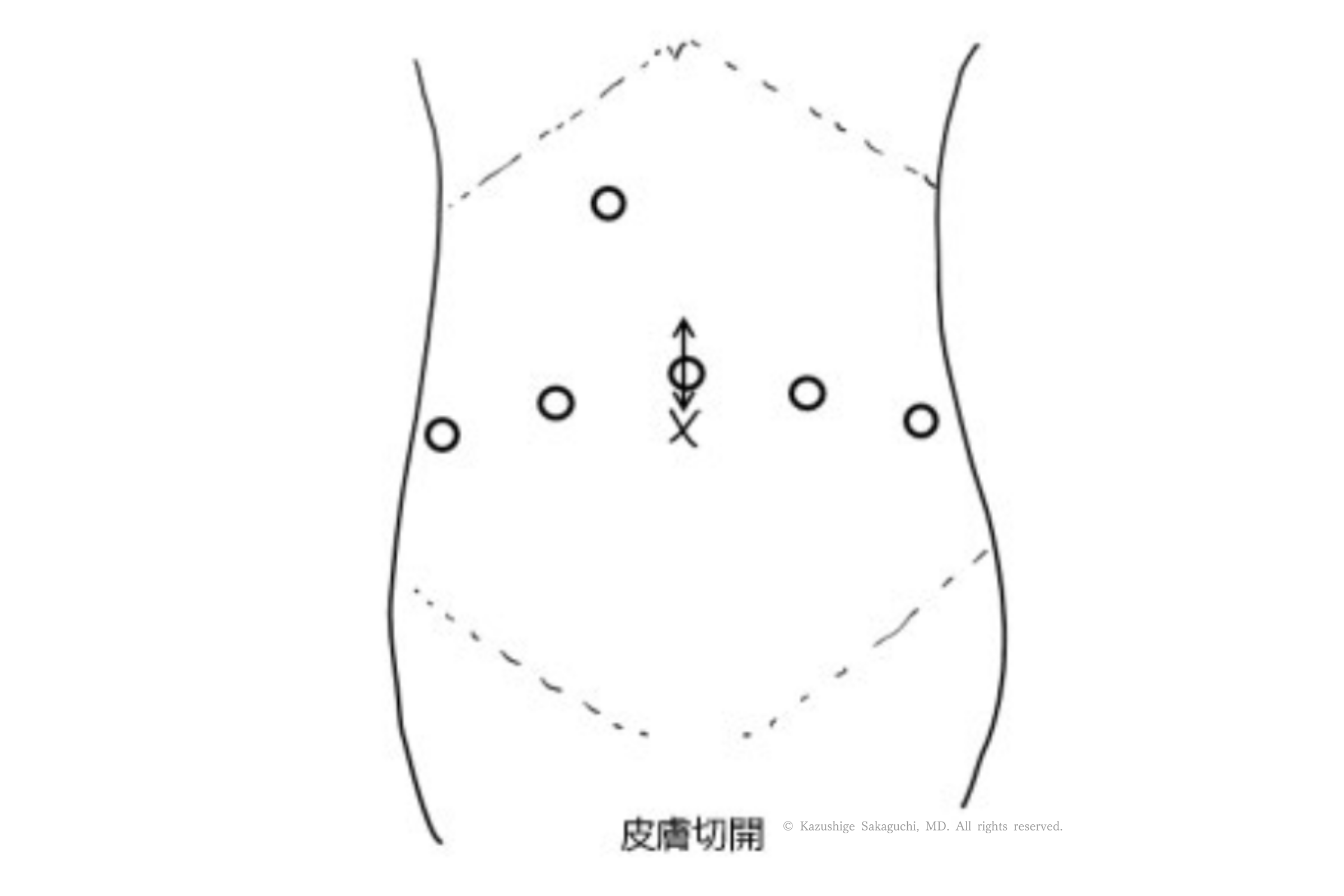 ロボット支援前立腺全摘で行う皮膚切開とポート配置を示した図