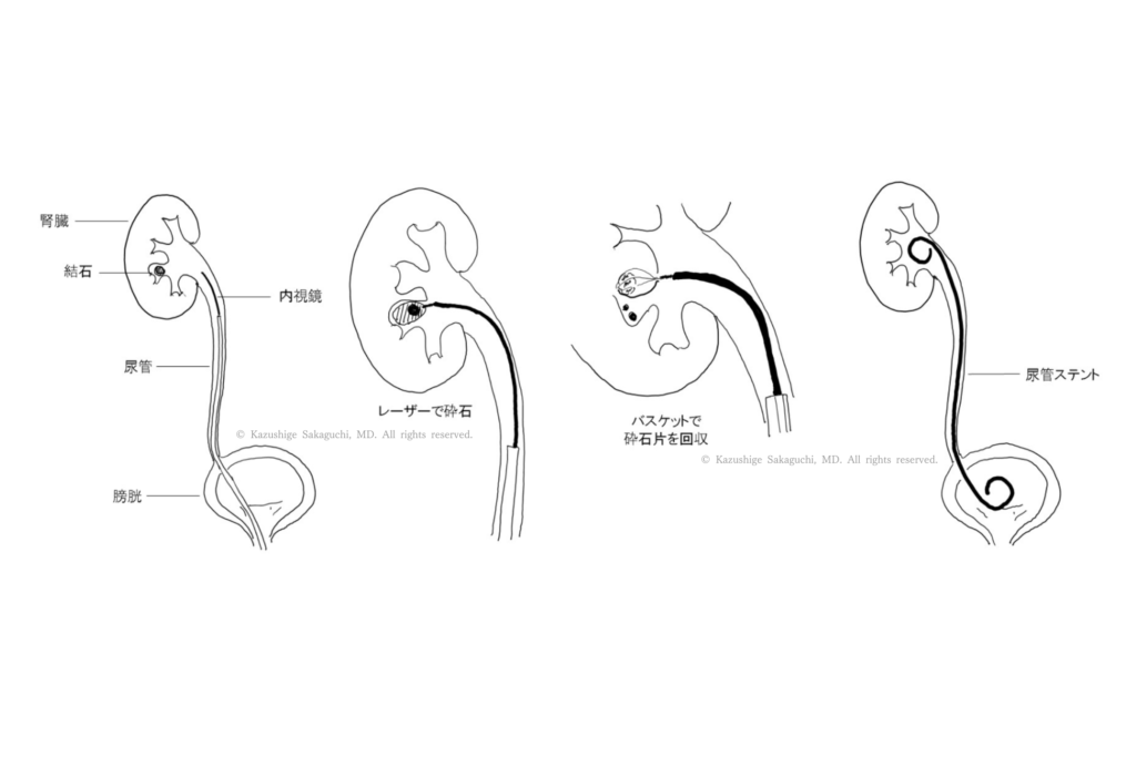 TUL（経尿道的尿管結石砕石術）で、内視鏡を尿管に挿入して結石をレーザーで砕石し、バスケットで回収した後に尿管ステントを留置する手順を示した図