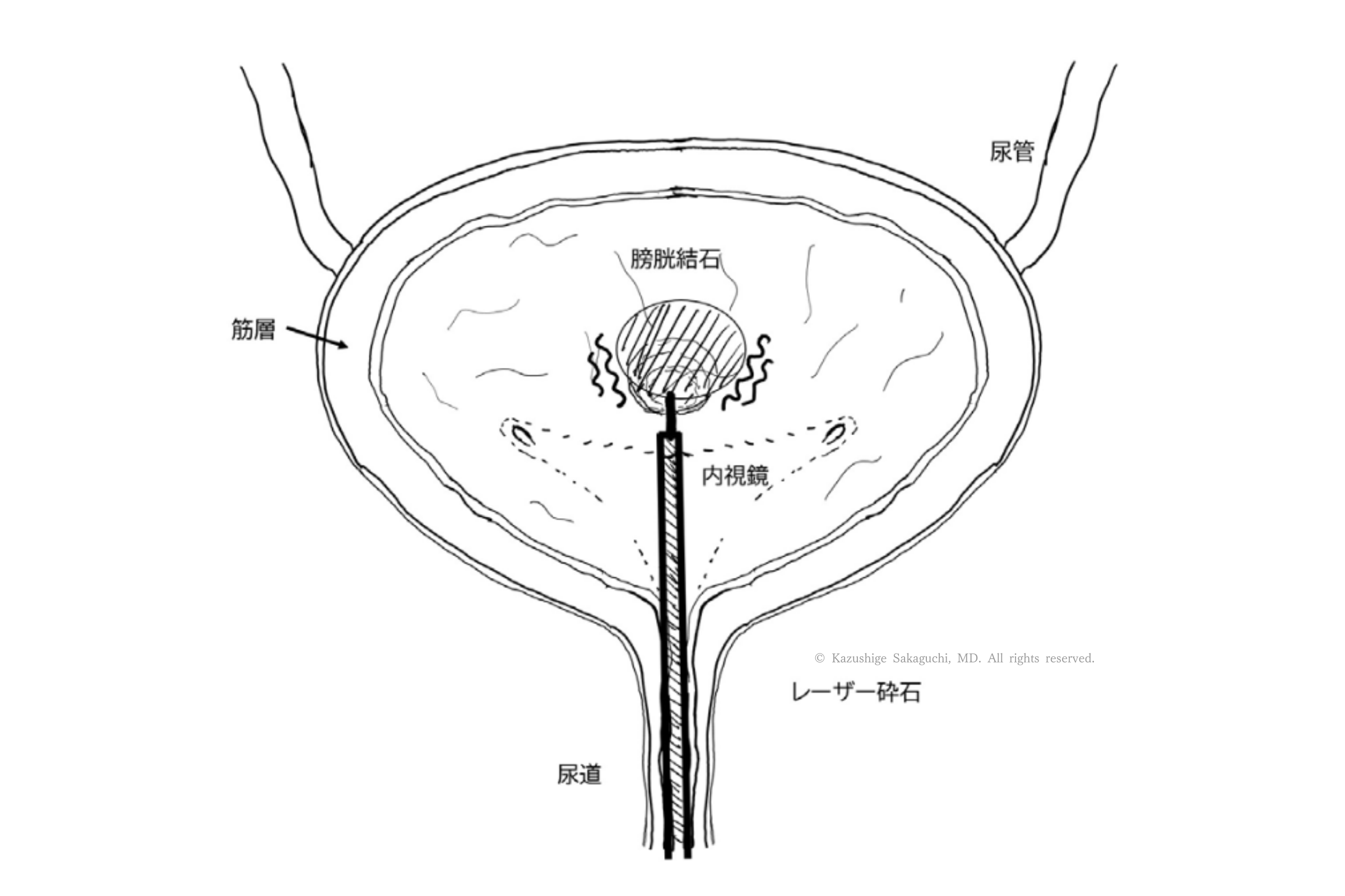 TUVL（内視鏡下膀胱結石砕石術）で、尿道から内視鏡を挿入し、膀胱内の結石をレーザーで砕石している様子を示した模式図。