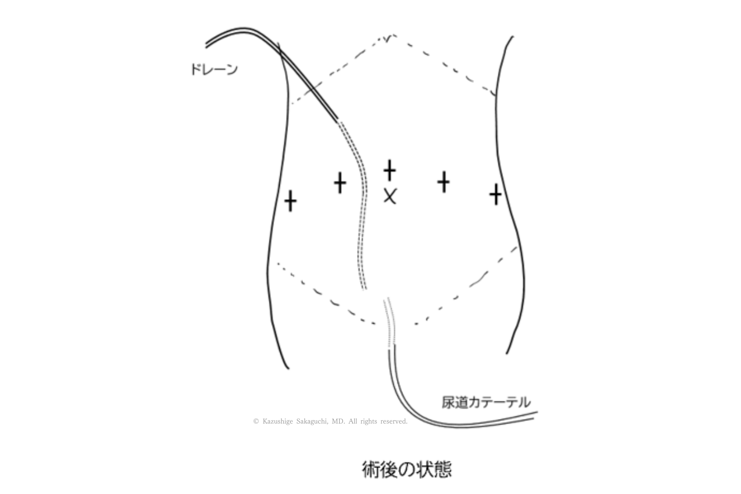 ロボット支援前立腺全摘後の尿道カテーテルとドレーン留置を示した図