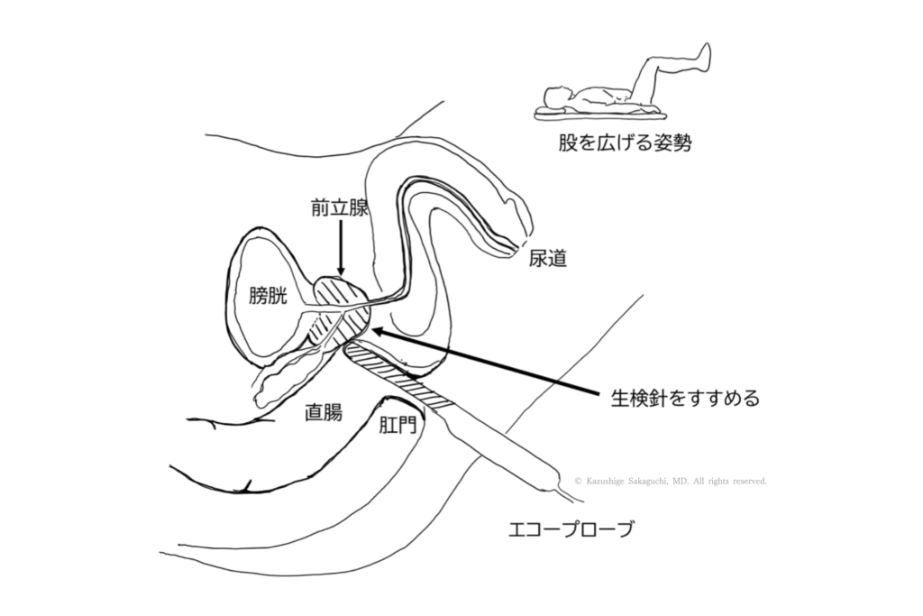 肛門から挿入したエコープローブで前立腺を確認し、生検針で組織を採取する前立腺生検の図