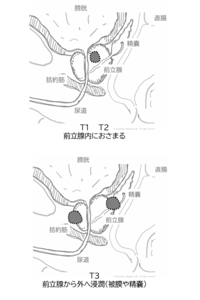 前立腺がんの進行度（T1・T2・T3）による広がりの違いを示した図