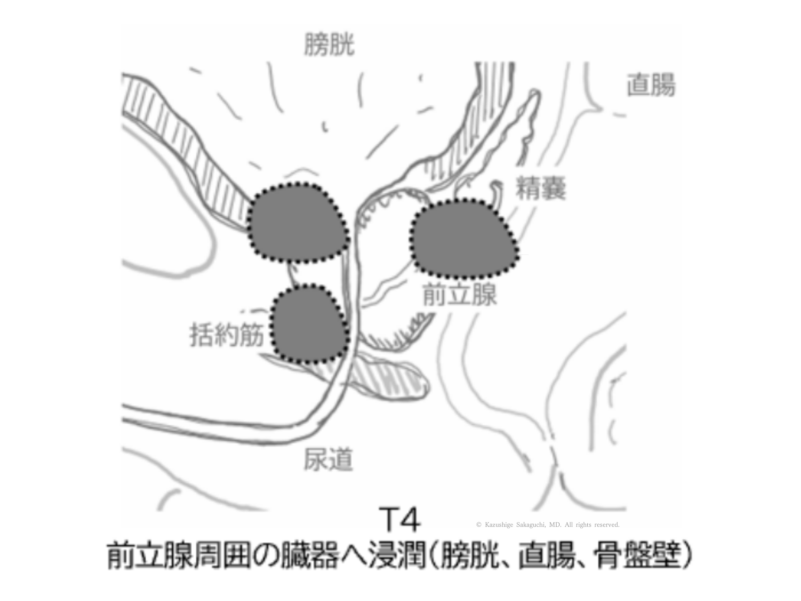 前立腺がんが周囲臓器へ浸潤した状態（T4）を示した図