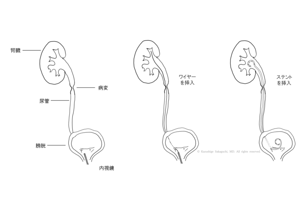 TUVL（内視鏡下膀胱結石砕石術）で、尿道から内視鏡を挿入し、膀胱内の結石をレーザーで砕石する様子を示した模式図です。