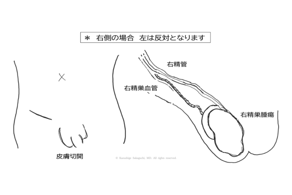 右側の高位精巣摘除で、皮膚切開の位置と精巣・精管・精巣血管の走行、精巣腫瘍の位置を示した図です。