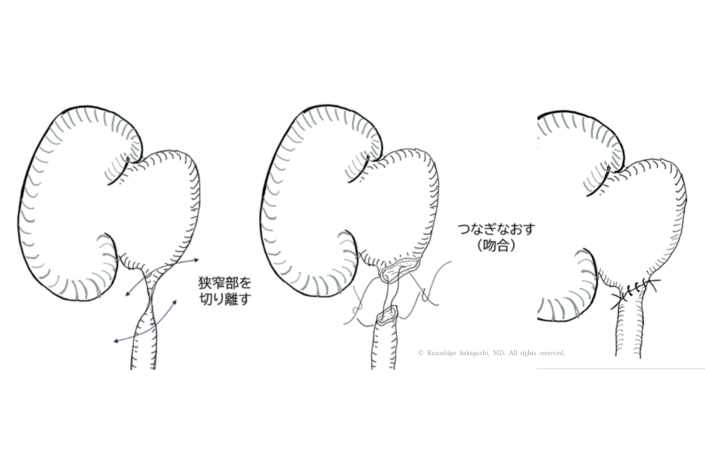 腎盂尿管移行部の狭窄部分を切除し、腎盂と尿管を縫合して再建するロボット支援腹腔鏡下腎盂形成術の手術手順を示した図です。