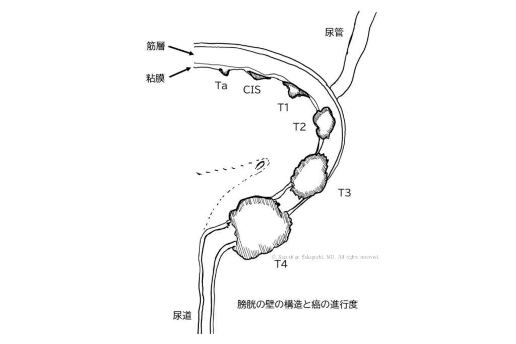 膀胱壁の層構造と、Ta、CIS、T1、T2、T3、T4のがんの深達度を示した図