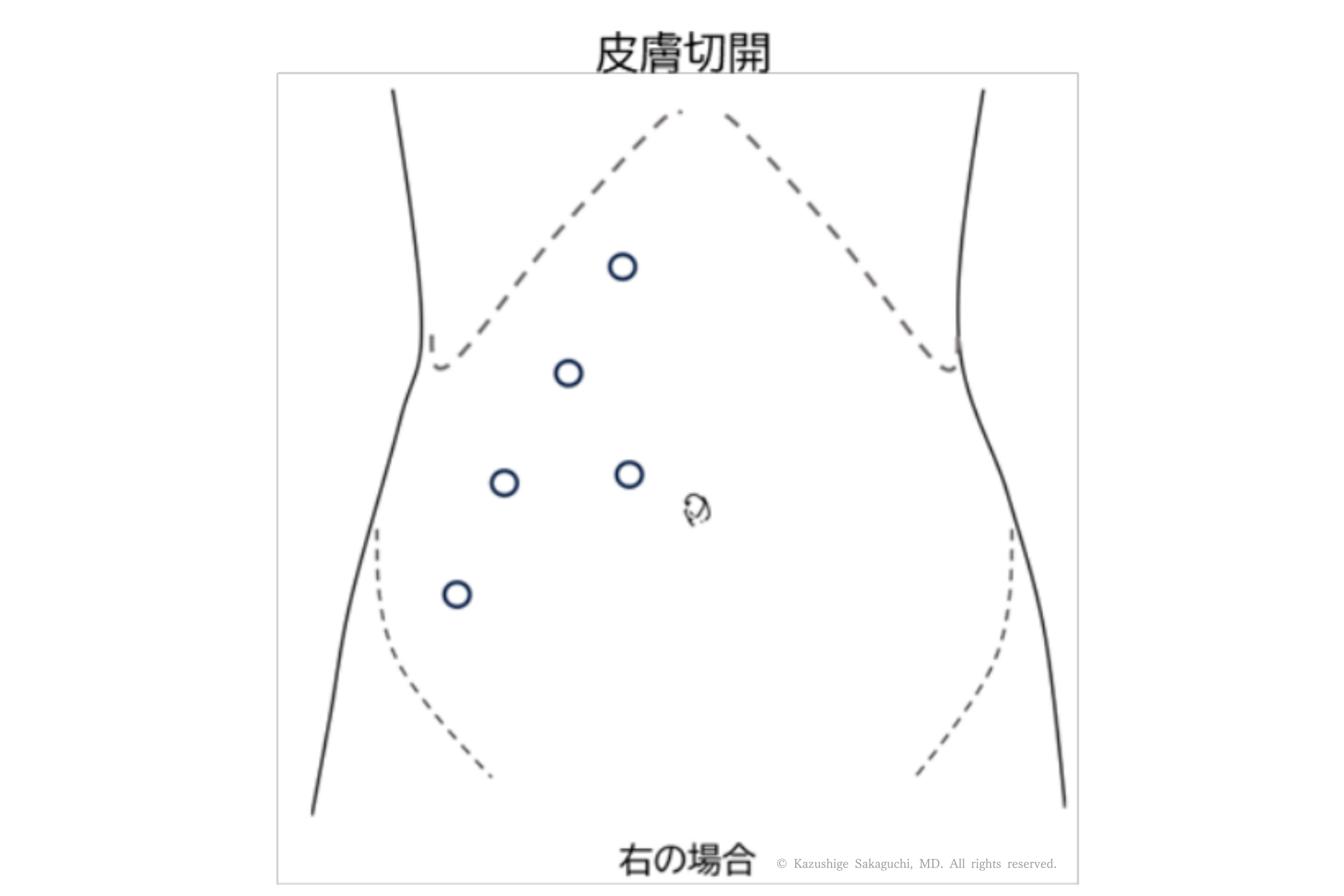 右側のロボット支援腹腔鏡下腎盂形成術で使用するポートの位置と皮膚切開部位を示した模式図です。