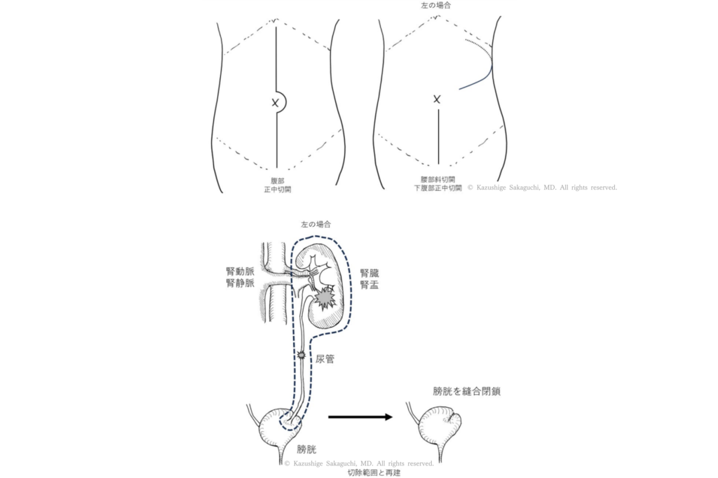左側に対する開腹下腎尿管全摘除術における腹部正中切開および斜切開の位置と、腎臓・尿管・膀胱の切除範囲、膀胱縫合閉鎖を示した模式図。