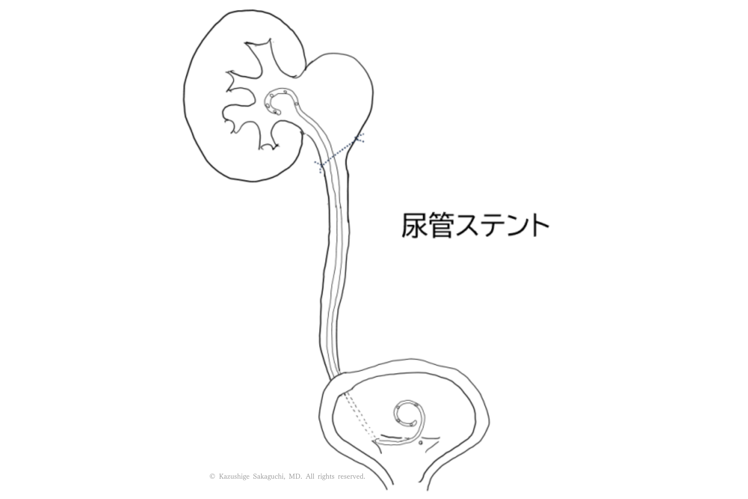 腎臓から膀胱まで尿管内に留置された尿管ステントの位置を示した図です。
