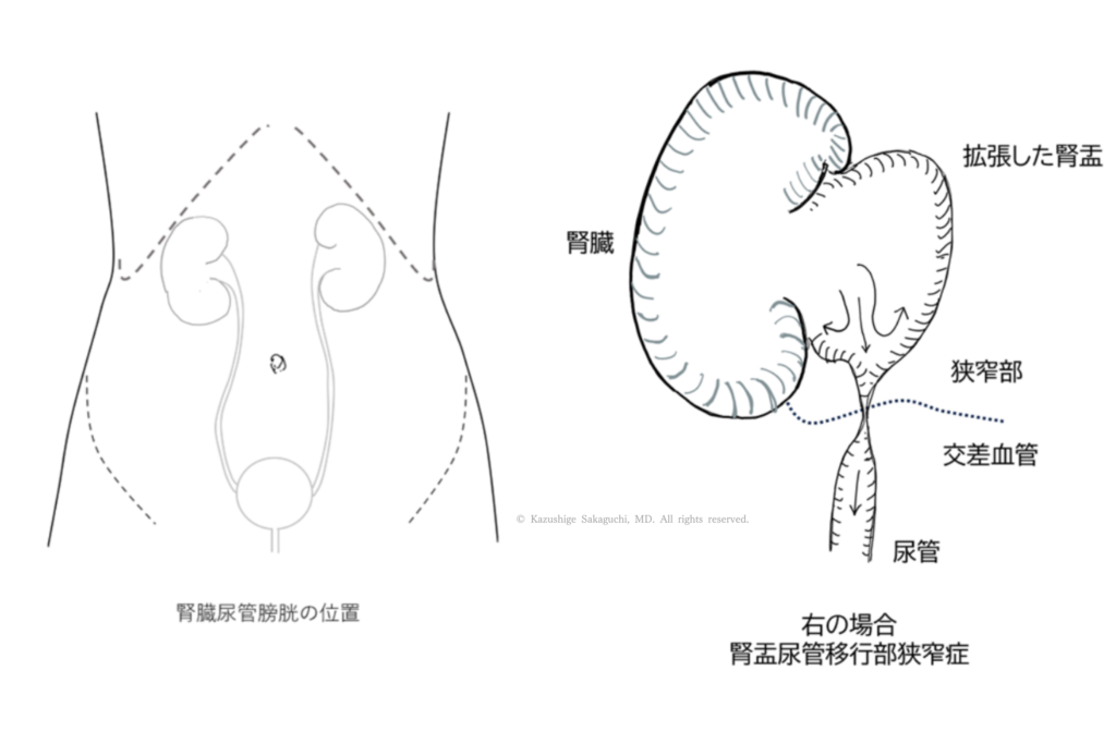 右側の腎盂尿管移行部狭窄症で、腎盂が拡張し狭窄部と交差血管が存在する状態を示した模式図です。