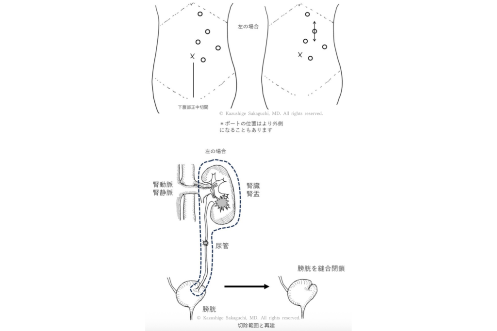 左側に対するロボット支援下腎尿管全摘除術の体表ポート配置と、腎臓・尿管・膀胱の切除範囲および膀胱縫合閉鎖を示した模式図。