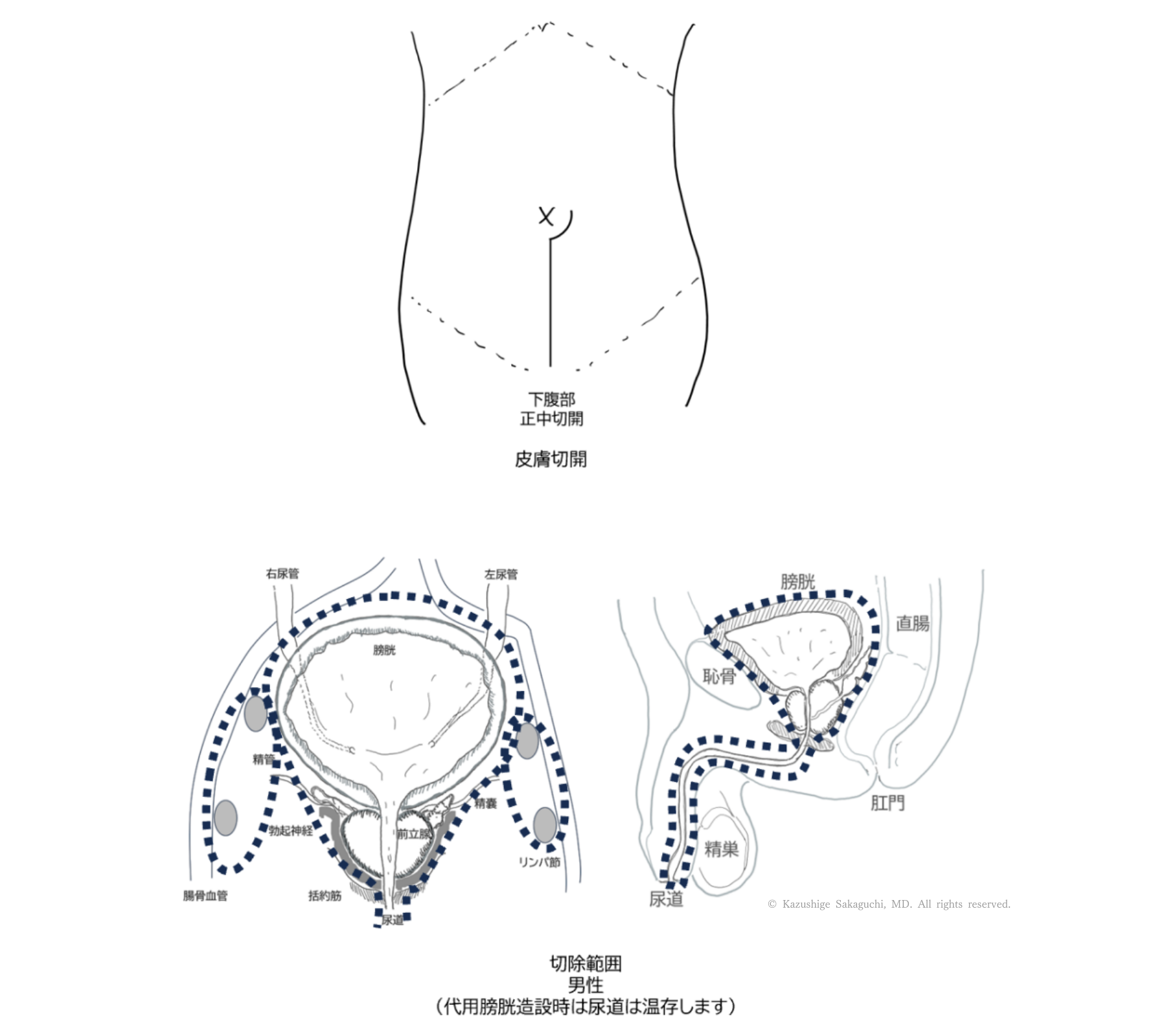 下腹部正中切開による開腹膀胱全摘除術の皮膚切開位置と、男性における膀胱・前立腺・尿道を含む切除範囲を示した模式図です。