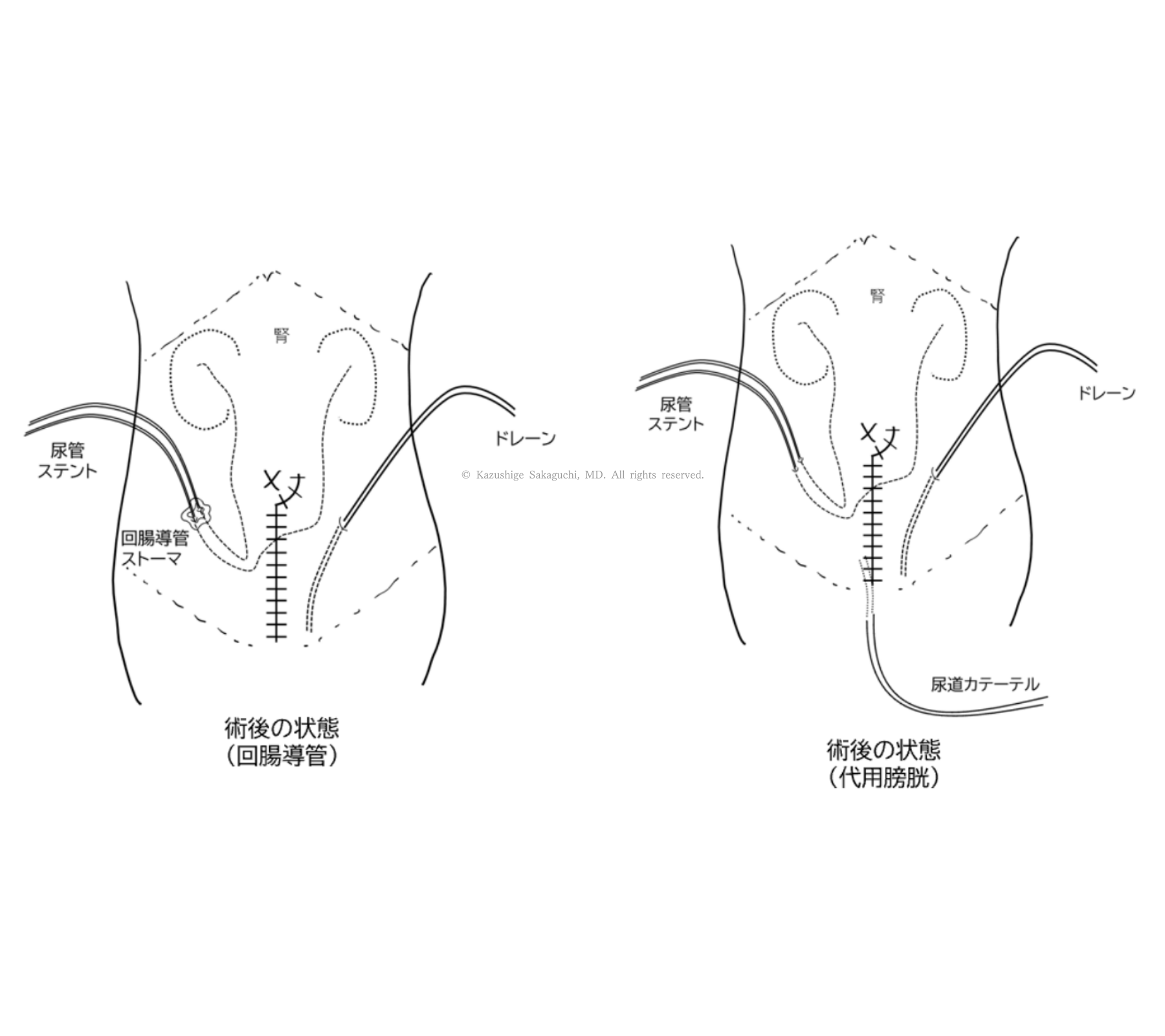 開腹膀胱全摘除術後における回腸導管および代用膀胱の状態を示し、尿管ステント、ドレーン、尿道カテーテルの位置関係を描いた模式図です。
