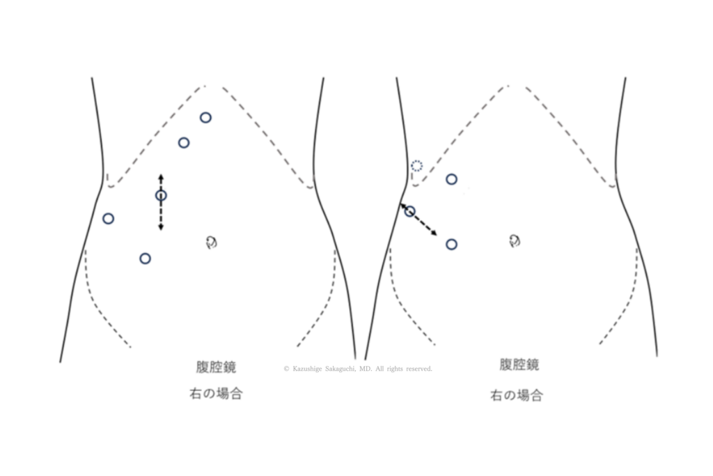 腹腔鏡下で右側の腎臓手術を行う際の、腹部表面におけるポート（トロッカー）挿入位置と配置を示した図です。