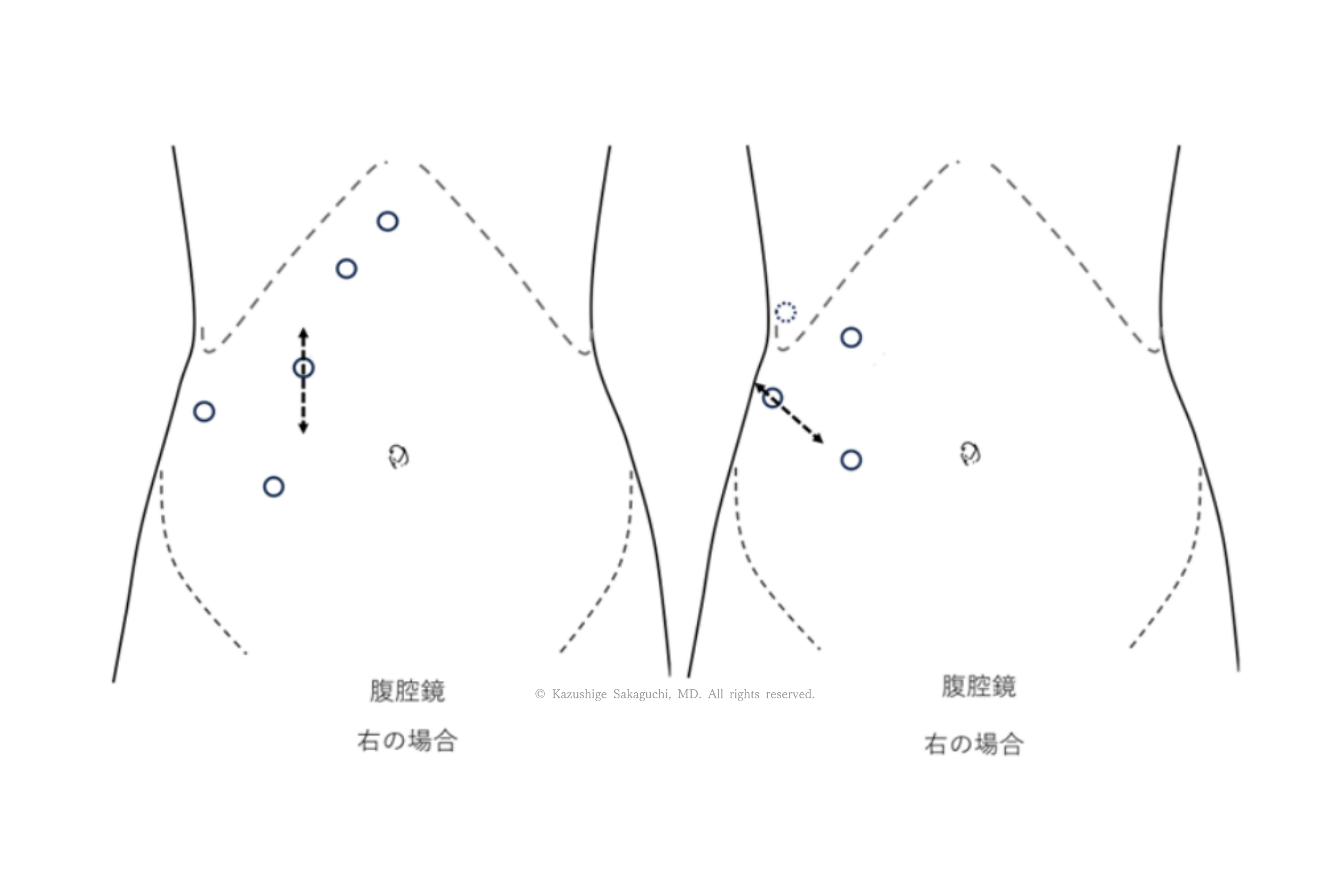 腹腔鏡下で右側の腎臓手術を行う際の、腹部表面におけるポート（トロッカー）挿入位置と配置を示した図です。