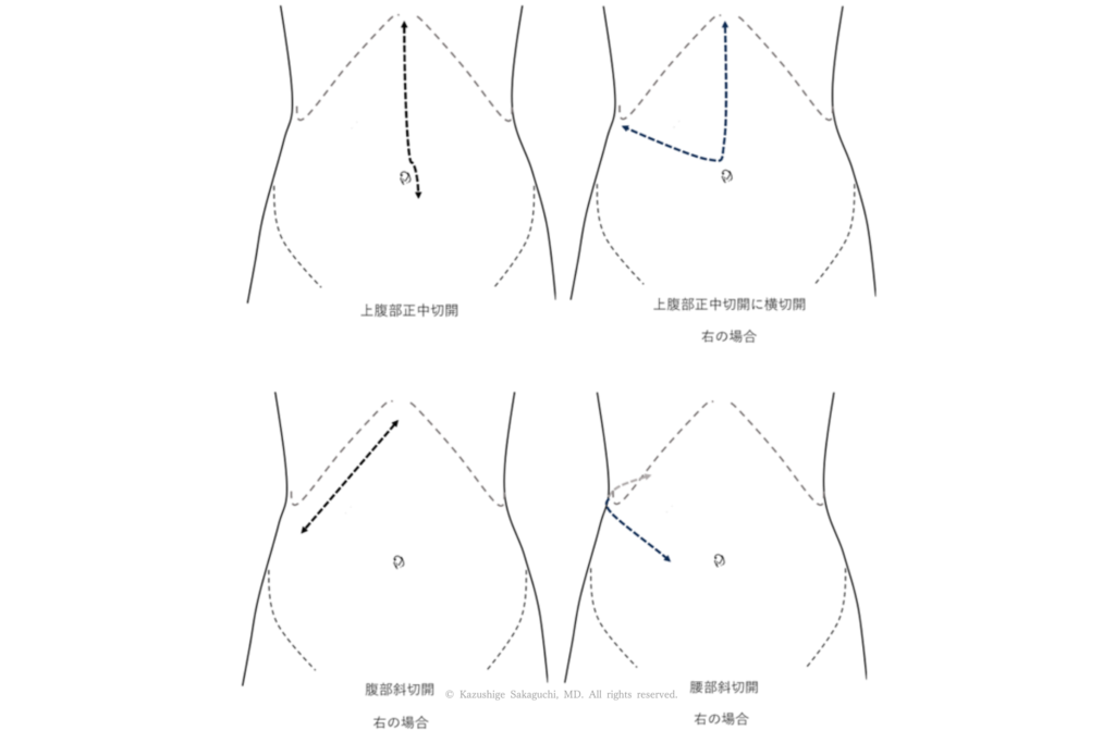 腎摘除術を行う際の開腹手術における切開位置を示した図で、上腹部正中切開、横切開、斜切開の代表的な方法を右側手術の場合として示している。