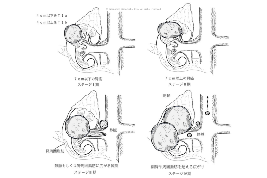 腎がんの進行度をステージⅠからⅣまで示した図で、腫瘍が腎臓内にとどまる状態から、腎周囲脂肪、静脈、副腎へと広がる過程を段階的に示している。