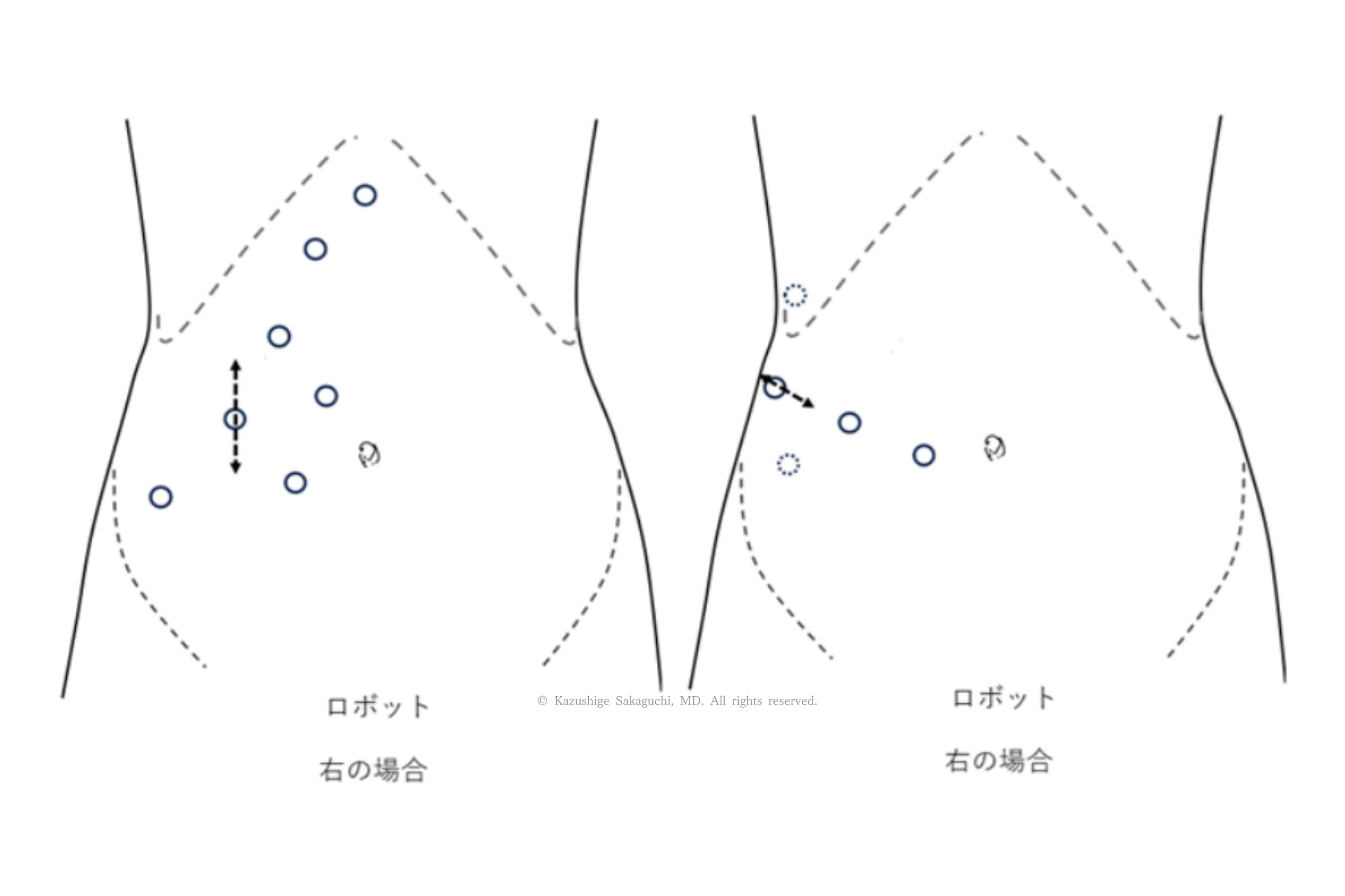ロボット支援腎摘除術を行う際のポート（器具挿入口）の配置を示した図で、右側腎臓の手術の場合におけるカメラポートおよび操作ポートの位置関係を示している。