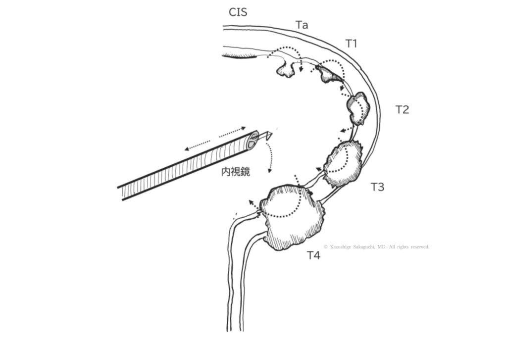 膀胱内に内視鏡を挿入し、CIS、Ta、T1〜T4までの膀胱がんの進行度を示した模式図