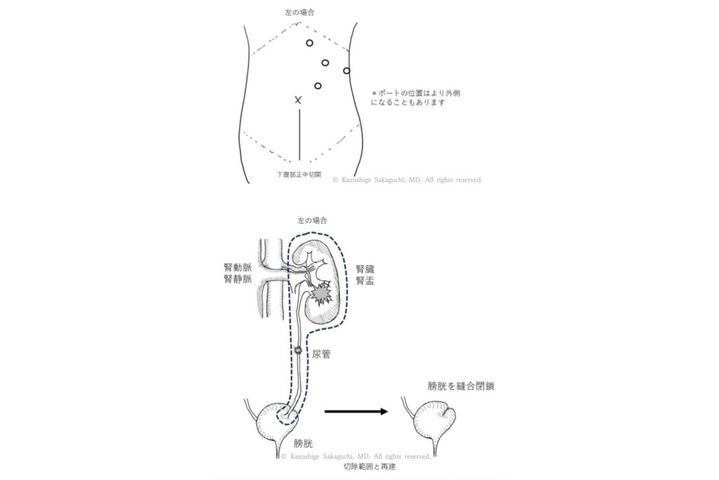 左側に対する腹腔鏡下腎尿管全摘除術における体表ポート配置と、腎臓・尿管・膀胱の切除範囲および膀胱縫合閉鎖を示した模式図。
