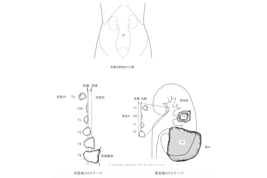 腎臓・尿管・膀胱の位置関係と、尿管癌および腎盂癌におけるTaからT4までのTステージ（進行度）を模式的に示した図。