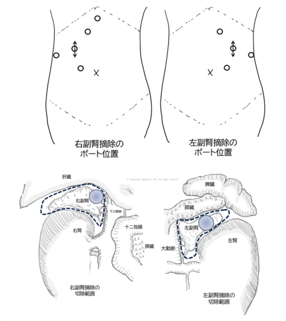右副腎摘除と左副腎摘除における腹部のポート位置と、周囲臓器との関係を踏まえた副腎の切除範囲を示した模式図です。