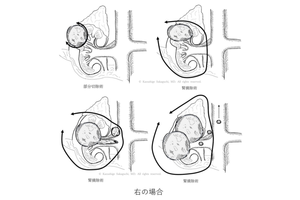 右腎腫瘍に対して、部分切除術と腎摘除術を行う場合の切除範囲と腎・血管の位置関係を比較した模式図です。