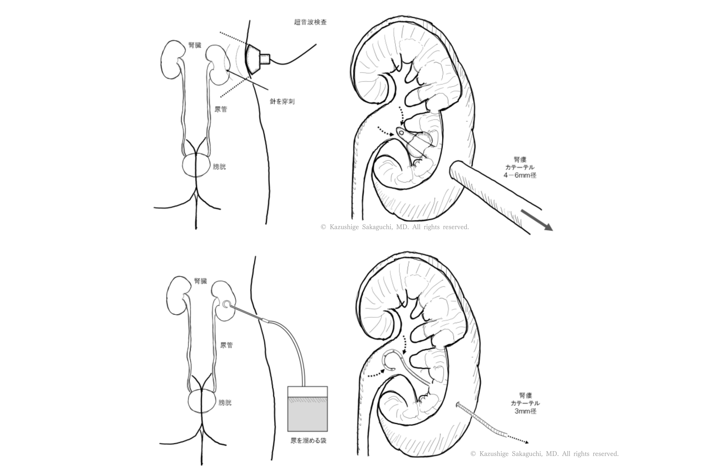 超音波で腎臓を確認しながら皮膚から腎盂へ針を刺入し、腎瘻カテーテルを留置して尿を体外へ排出する経皮的腎瘻造設術の手順を示した図です。