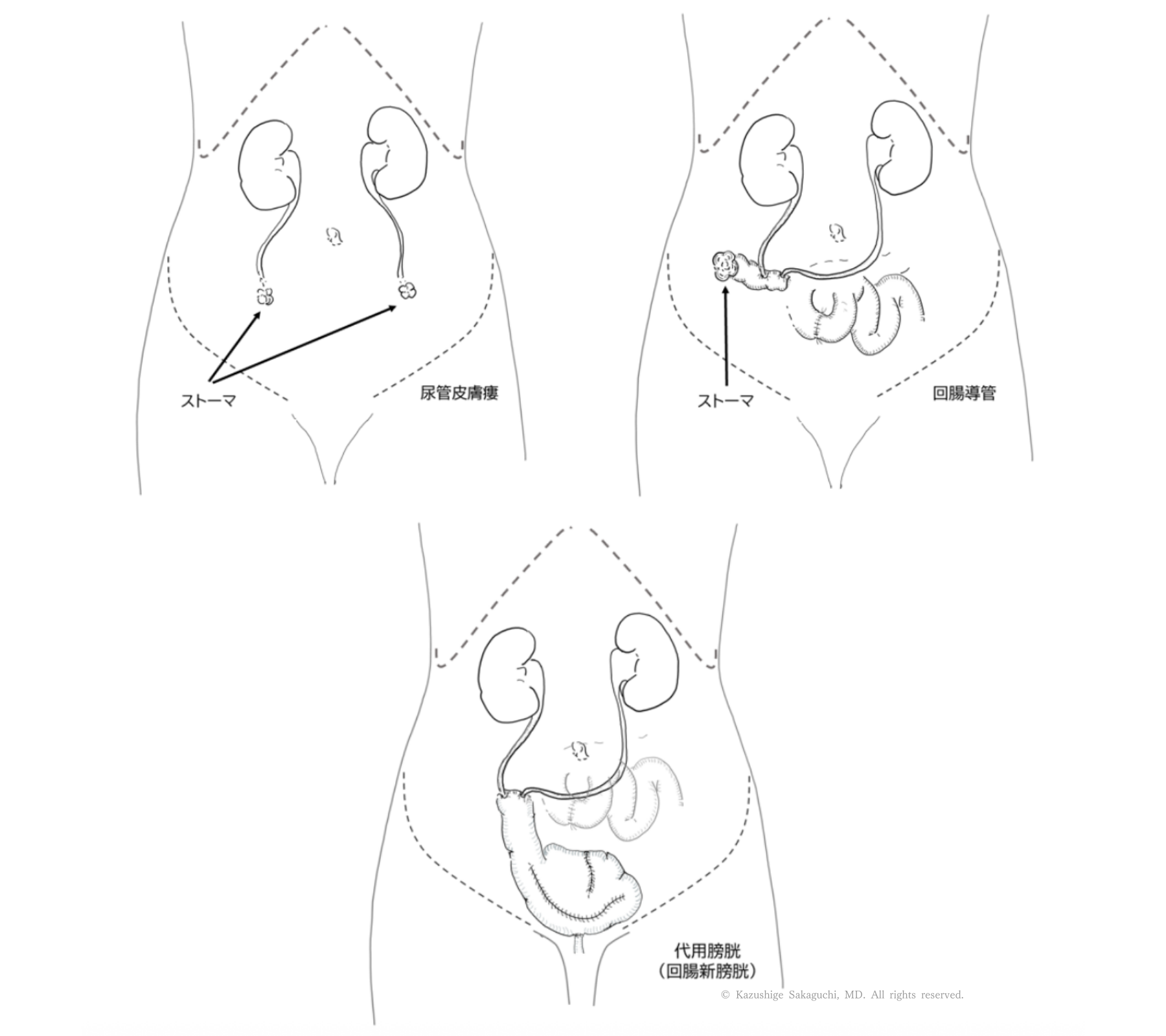 膀胱全摘除後の尿路変更として、尿管皮膚瘻、回腸導管、回腸新膀胱（代用膀胱）の3つの方法を示した模式図