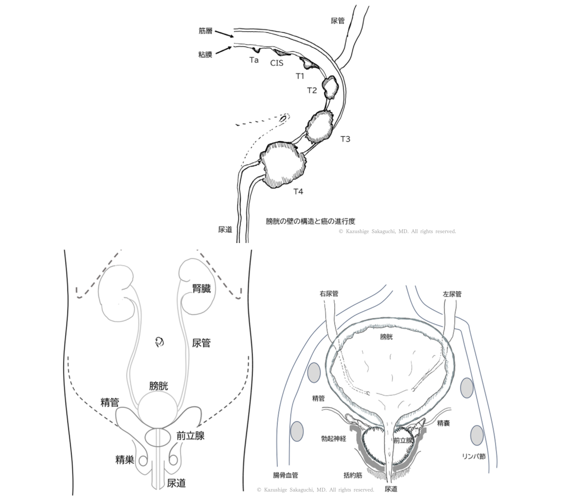 膀胱壁の構造と膀胱がんの進行度（Ta・CIS・T1〜T4）および男性骨盤内臓器との位置関係を示した解剖図