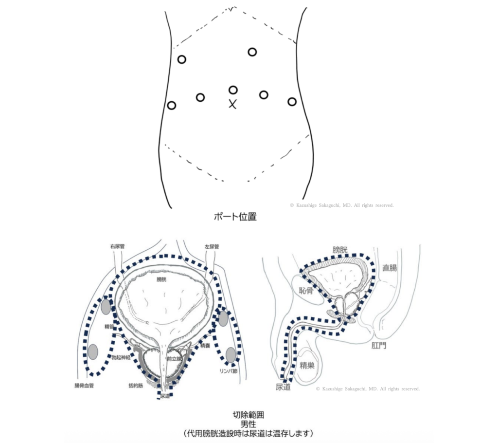 男性の膀胱全摘除術における腹部ポート位置と膀胱・前立腺・精嚢・直腸の切除範囲を示した模式図
