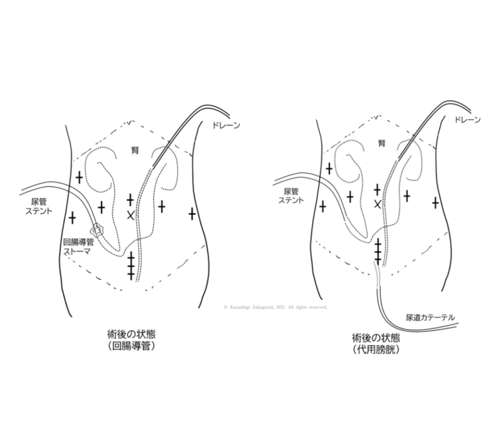 膀胱全摘除術後における回腸導管と代用膀胱それぞれの術後状態を示した模式図