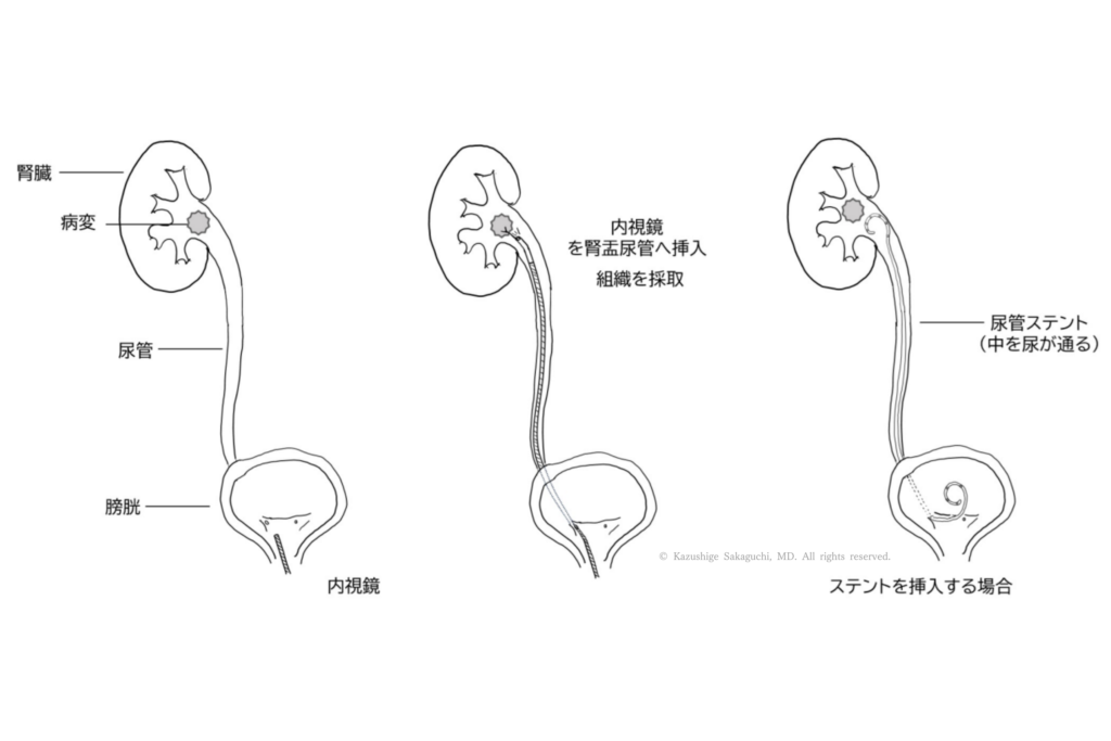 腎盂や尿管の病変に対し、膀胱から内視鏡を挿入して観察・組織採取を行い、必要に応じて尿の通り道を確保する尿管ステントを留置する手技を示した図