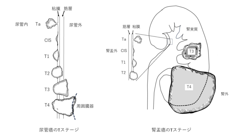 尿管癌および腎盂癌におけるTaからT4までのTステージ（進行度）を模式的に示した図。