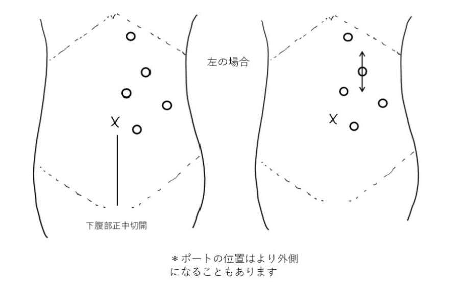 左側に対するロボット支援下腎尿管全摘除術の体表ポート配置