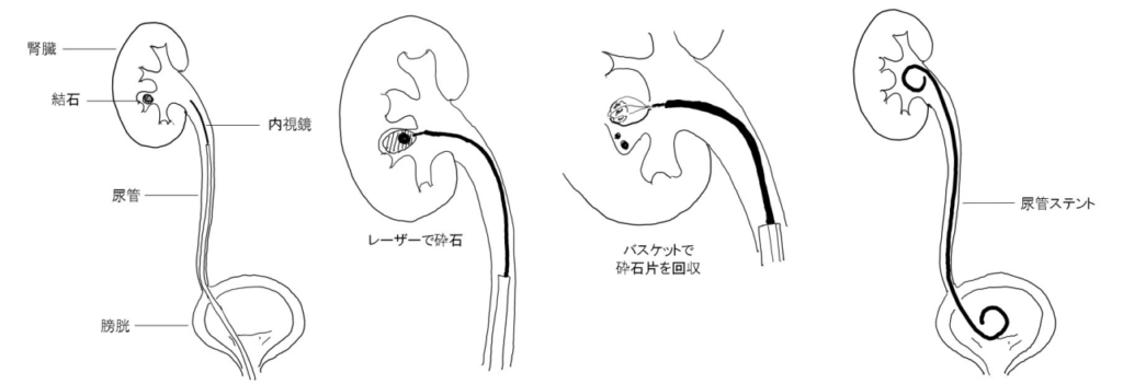 TUL（経尿道的尿管結石砕石術）で、内視鏡を尿管に挿入して結石をレーザーで砕石し、バスケットで回収した後に尿管ステントを留置する手順を示した図