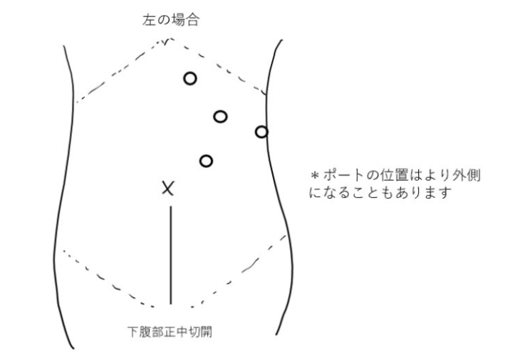 左側に対する腹腔鏡下腎尿管全摘除術における体表ポート配置