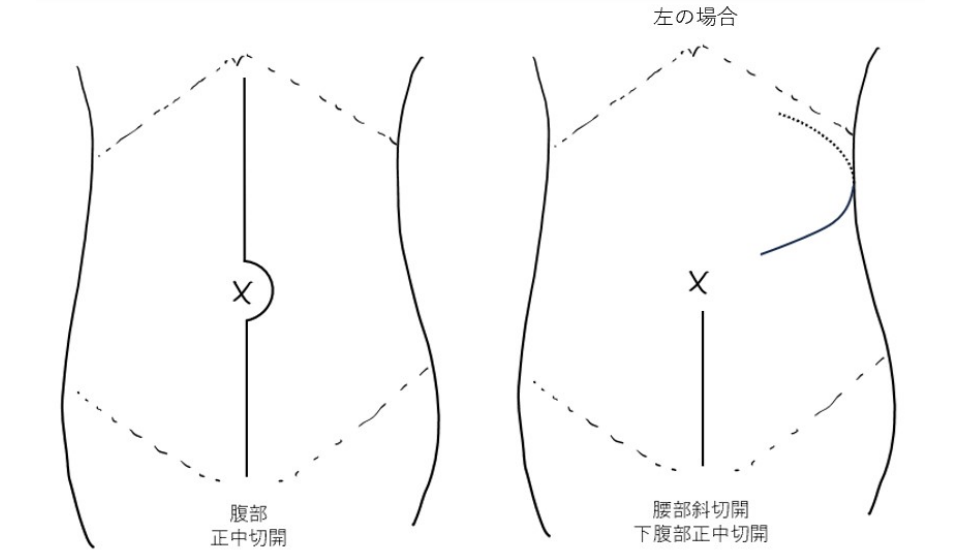 左側に対する開腹下腎尿管全摘除術における腹部正中切開および斜切開の位置